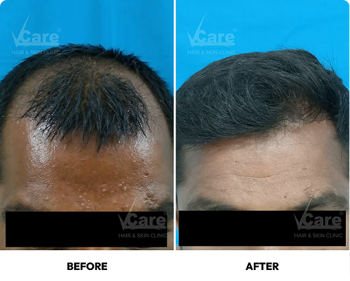 Graft-implantation-process